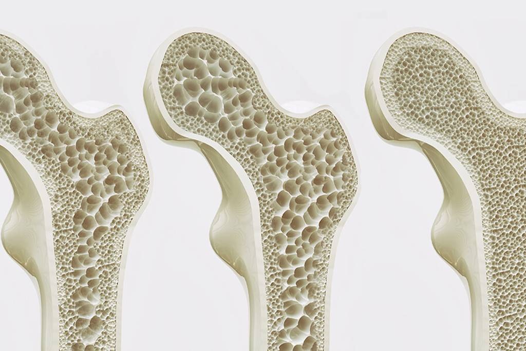Alimentación adecuada desde los primeros años de vida y actividad física previenen osteoporosis